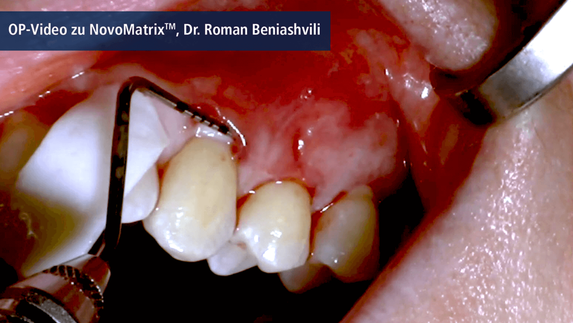 OP-Video zur Anwendung von NovoMatrix - die Tunnel-Technik