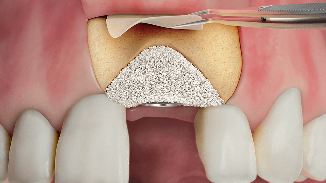 Aumento generale della cresta alveolare