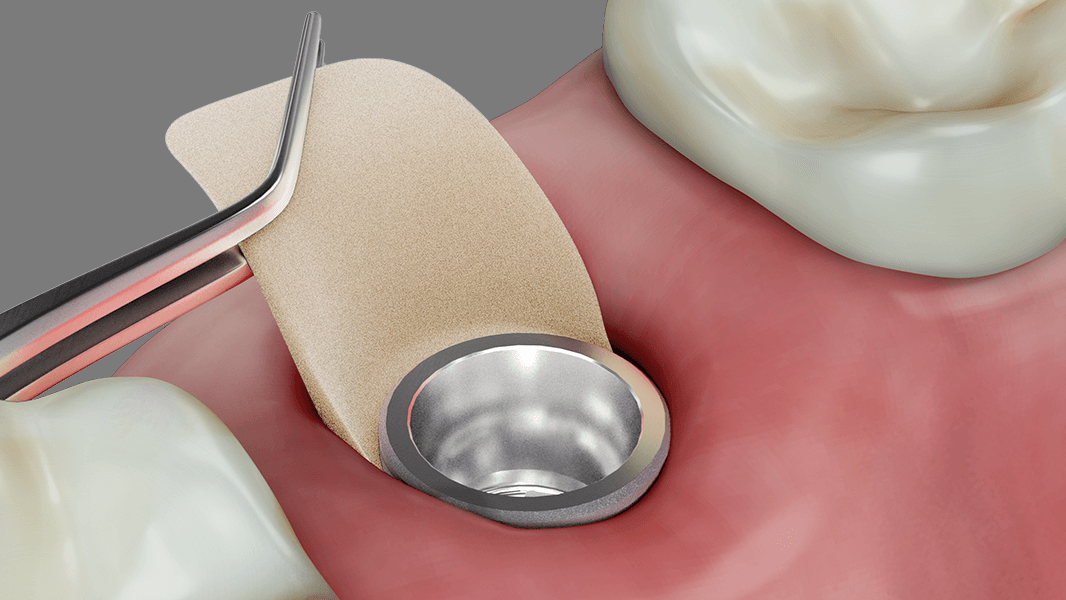 Ispessimento del tessuto intorno a impianti e denti con la tecnica a pouch