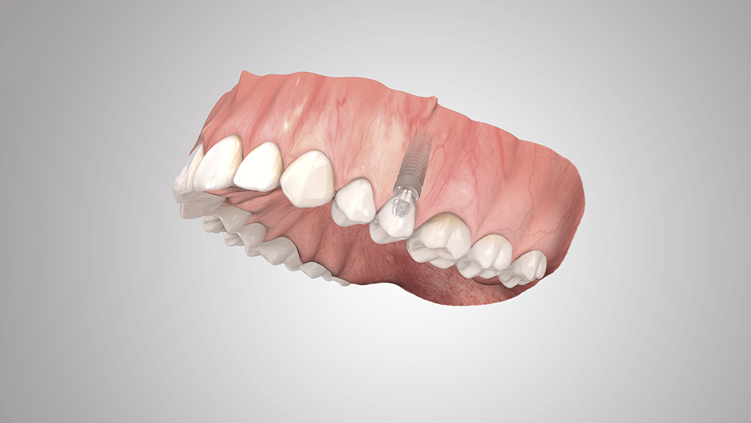 COMFOUR System single-tooth restoration
