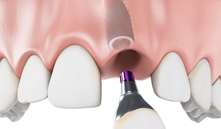 The final CONELOG restoration with an emergence that directly matches the soft tissue and offers esthetic advantages.